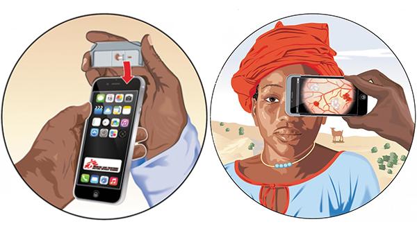 Smartphones, die Leben retten: Malaria-Diagnose für Kinder